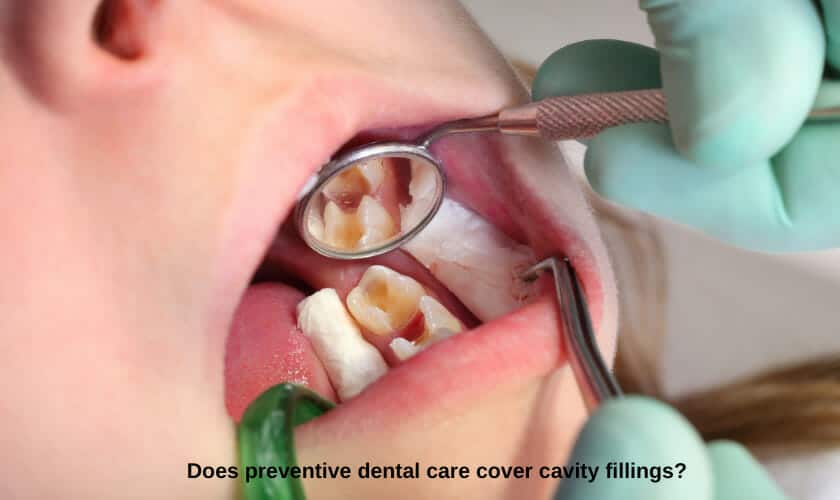 Filling Options for Cavities – Comfort Care Family Dental P.C.